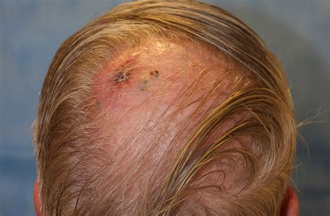 scalp melanoma icd 10
